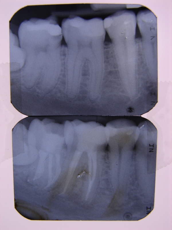 Endodoncja - zdjęcie